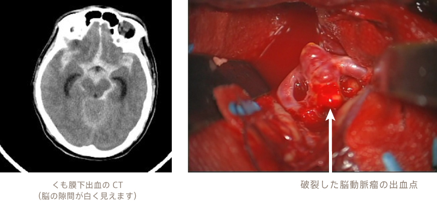 破裂 脳 動脈 瘤